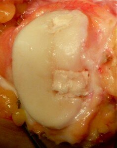 Synthetic cartilage inserted
