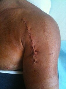 Just after Surgery